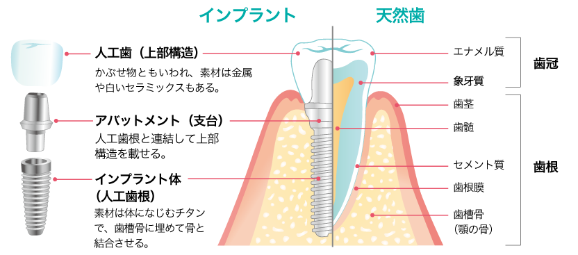 インプラントと天然歯の違い　インプラントの構造はインプラント体（人工歯根）を埋め込み、アパットメント（支台）の上に