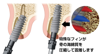 歯がない期間を作らない抜歯即時埋入法では特殊なフィンが骨の海綿質を圧縮して固着します